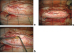 Fig. 2a-c: Spinal Teratoma