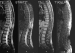 This Image - Fig. 3: Spinal Teratoma