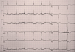 Aktuelles Bild - Abb. 1: EKG-Beispiel