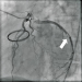 Abb. 2: Ramus circumflexus