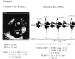 Fig. 1: LAEF (Left Atrial Ejection Force)