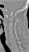 Abb. 1: Rheumatische Wirbelsäule