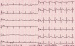 Abb. 1: Hypokaliämie