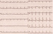 Aktuelles Bild - Abb. 2: T-Wellen-Morphologie