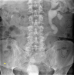 Abb. 2: Implantationsstenose
