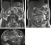 Abb. 1a-c: Appendizitis-Diagnose