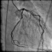 Abb. 11: Angiogramm
