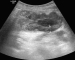 Abb. 1: Tumor
