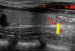 Abb. 9: Alkoholablation - Schilddrüse