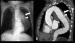 Abb. 3a-b: Aorta thoracalis - Aortenruptur