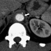 Abb. 4: Aorta abdominalis - Pannus