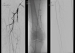 Abb. 1: CTO-Revaskularisation