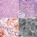 Aktuelles Bild - Abb. 1A-D: Hyper-IgG-Syndrom