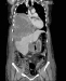 Abb. 2: Biphasisches Synovialsarkom