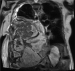 Aktuelles Bild - Abb. 3: Biphasisches Synovialsarkom