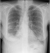 Abb. 4b: Biphasisches Synovialsarkom