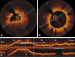 Abb. 4a-c: Thrombus - Stent 