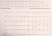 Aktuelles Bild - Abb. 1: Notfall-EKG