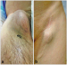 Abb. 1a-b: Aneurysma