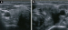 Aktuelles Bild - Abb. 1a-b: Thyreoiditis