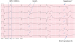 Abb. 4: EKG