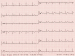 Aktuelles Bild - Abb. 1: EKG