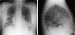 Abb. 1: Medikamentenassoziierte diffuse parenchymatöse Lungenerkrankung - DILD