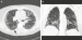 Abb. 1a-b: Usual Interstitial Pneumonia - UIP