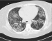 Abb. 3: Non-specific Interstitial Pneumonia - NSIP