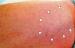 Abb. 1: Aneurysma spurium