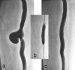 Abb. 5a-c: Aneurysma spurium