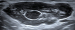 Abb. 8: Ultraschall-Lymphknoten