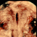 Abb. 5: Ultraschall-Hormonspirale