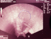 Abb. 3: Myom