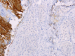Abb. 10: Tumor