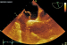 Aktuelles Bild - Abb. 1: Vorhofseptumaneurysma