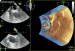 Abb. 2: Vorhofseptumaneurysma