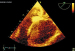 Abb. 3: Thromboemolus
