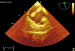 Abb. 4: Thromboembolus