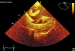 Abb. 5: Thromboembolus