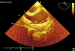Abb. 6: Thromboembolus