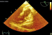 Abb. 7: Thromboembolus