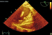 Aktuelles Bild - Abb. 8: Thromboembolus