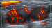 Abb. 3: Lymphknoten-Ultraschall