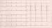 Aktuelles Bild - Abb. 1: EKG