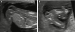 Aktuelles Bild - Abb. 3a-b: Spina bifida – Pränataldiagnose