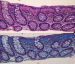 Abb. 2a-b: Eosinophiles Kollagenband