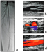 Abb. 3a-d: Arteria femoralis superficialis