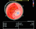 Aktuelles Bild - Abb. 3: Speckletracking