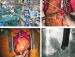 Abb. 4a-d: ECMO